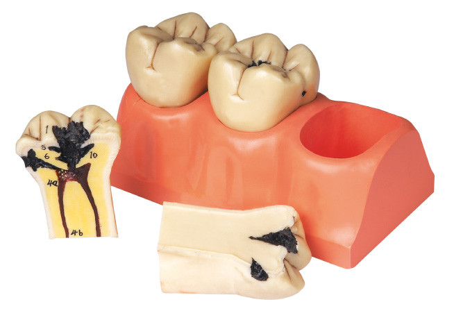見習い期間および学生の訓練のための歯科病気の切り裂かれた人間の歯モデル