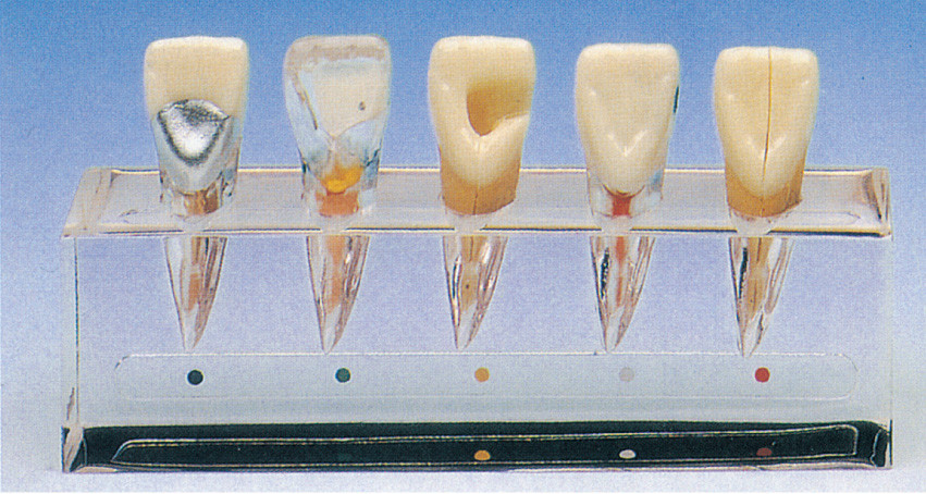 歯学部の訓練のための 5 部についての臨床歯の病気シリーズ モデル