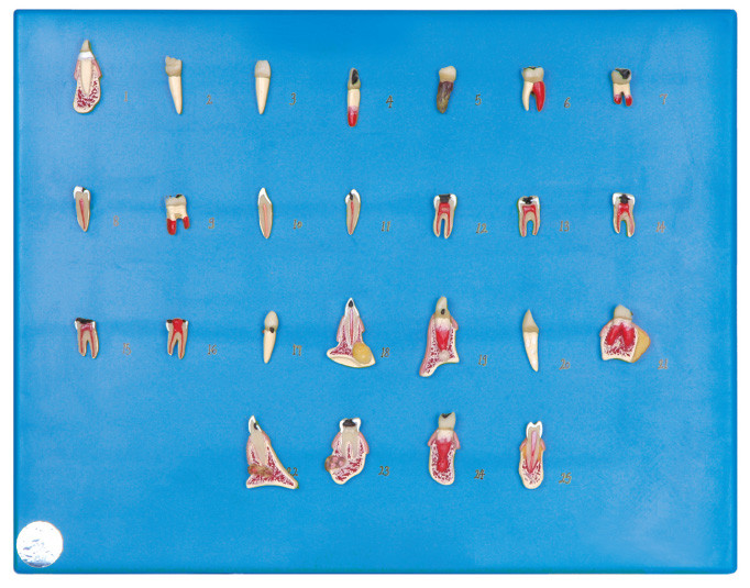 25 種類の歯科病気シリーズ病院のための人間の歯モデル、学校の訓練
