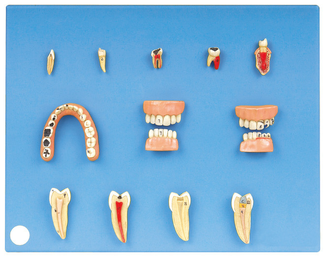見習い期間および学生の訓練のための高度ポリ塩化ビニールから成っている歯科病気モデル