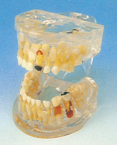 乳歯の人間の歯モデル/透明な病理学は歯学部の訓練のために模倣します
