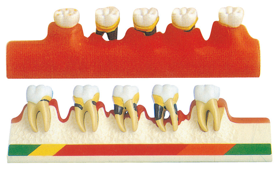 歯周病モデルは歯学部の訓練のための 5 部を含んでいます