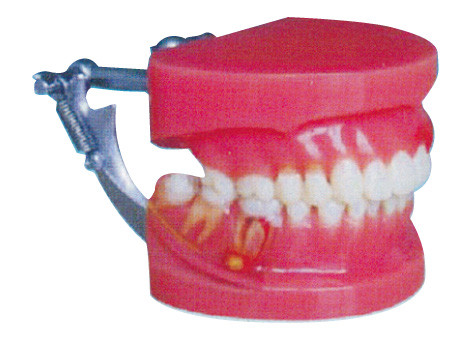 赤くおよび白い歯周病のデモンストレーションの人間の歯のモデル大将医者