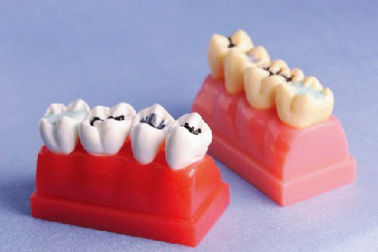 実物大 4 回の密封剤および象眼細工のデモンストレーション モデルのための人間の歯モデル